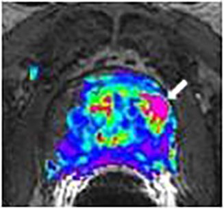 prostate_mri_9